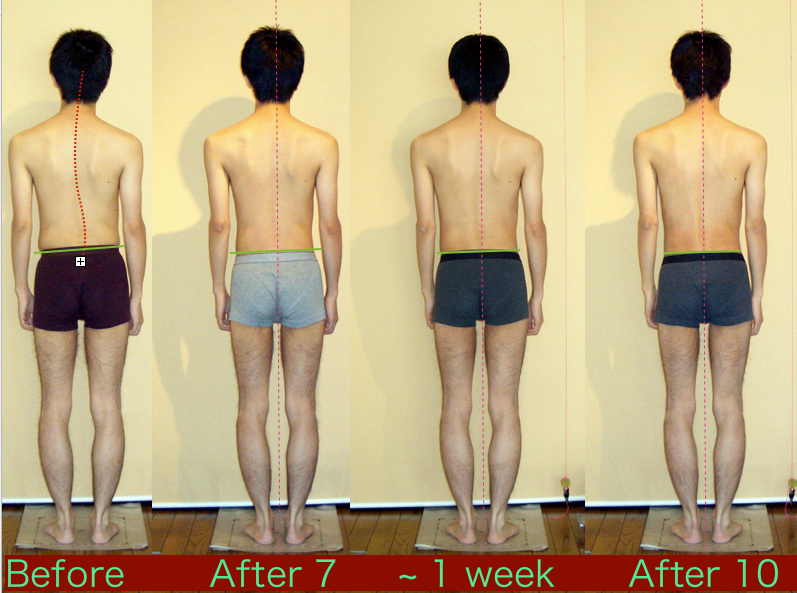ロルフィングと脊柱側湾